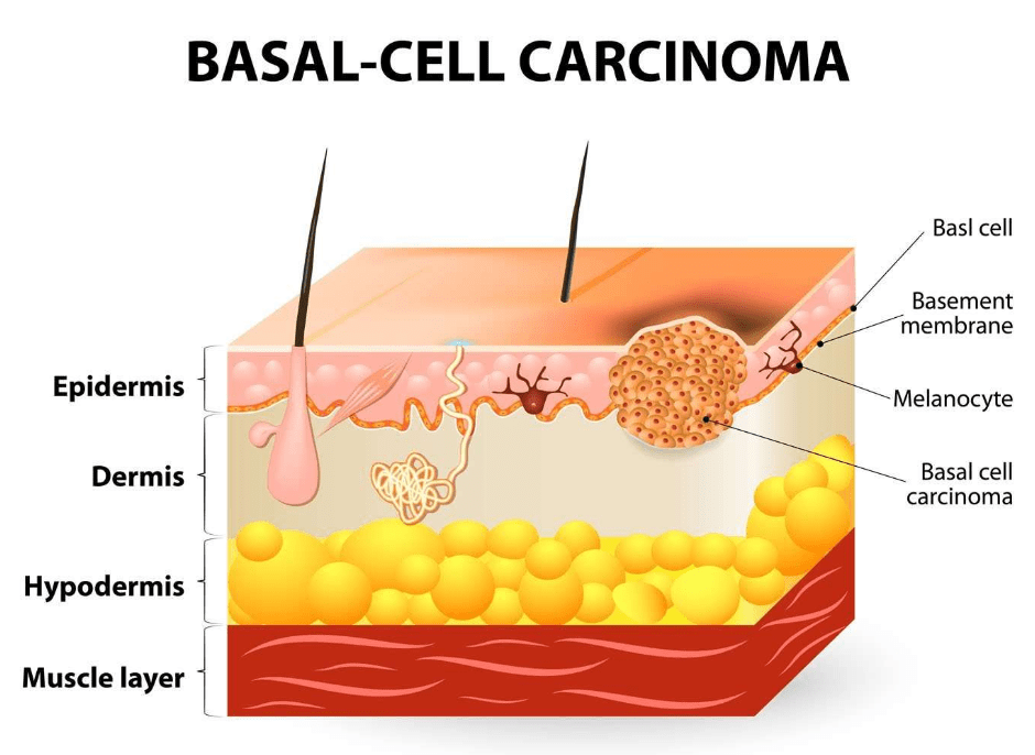 cura do cancer de pele com cirurgia
