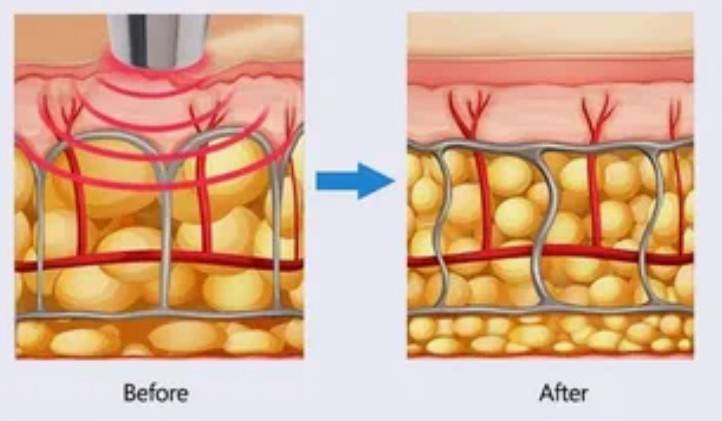 vaser e safer: lipo ultrassônica