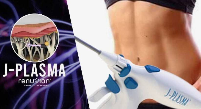 renuvion e argoplasma na lipoaspiração
