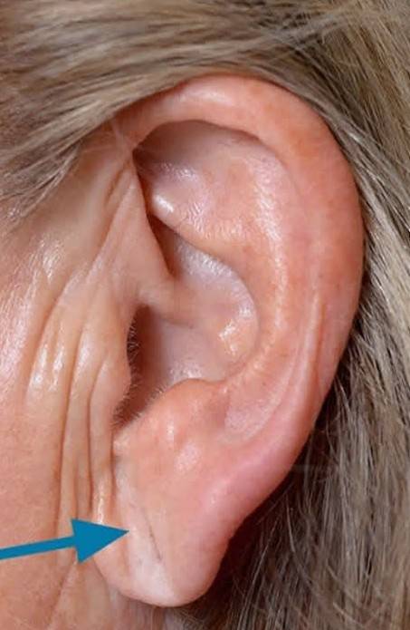 lobuloplastia não cirúrgica