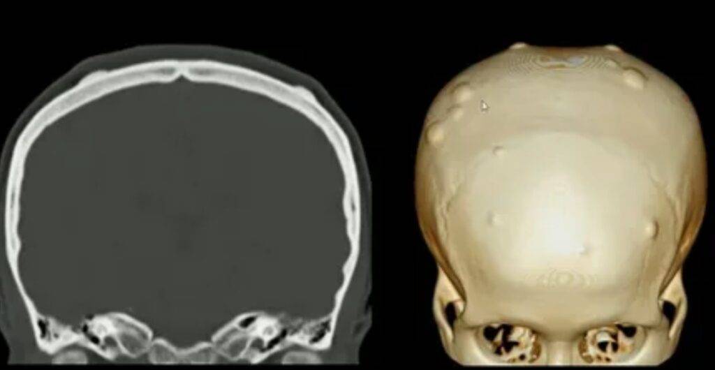 Diagnóstico do osteoma