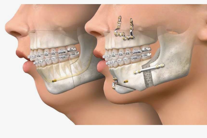 antes e depois cirurgia ortognática