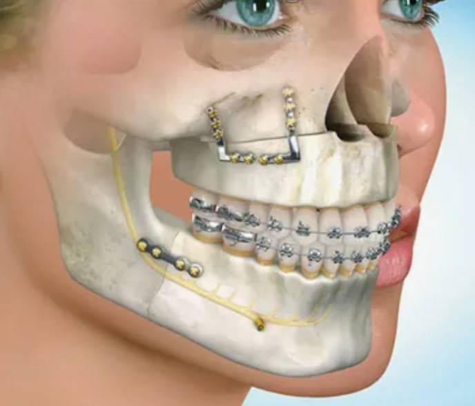 como é a cirurgia ortognática
