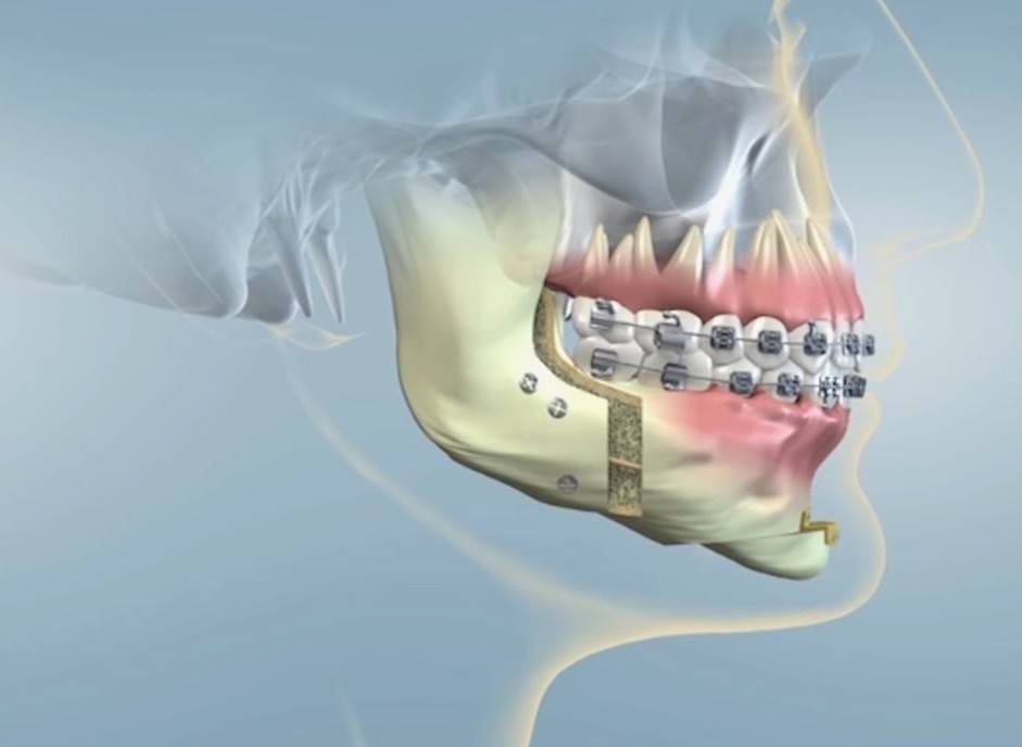 cirurgia ortognática em curitiba