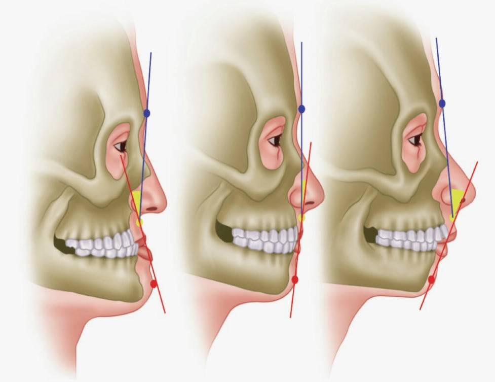 Classe 1, classe 2 e classe 3 - cirurgia ortognática.
