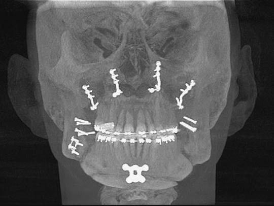 após cirurgia ortognática