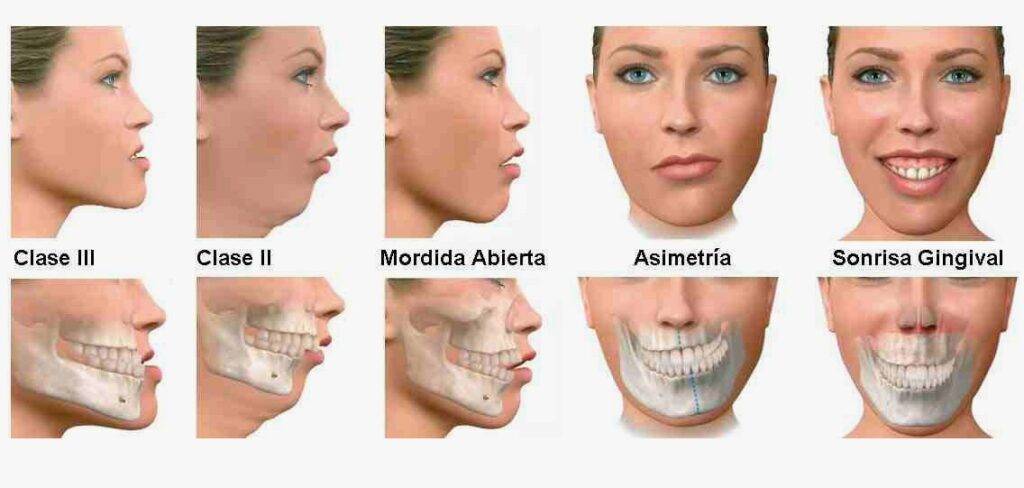 cirurgia ortognática e alterações faciais
