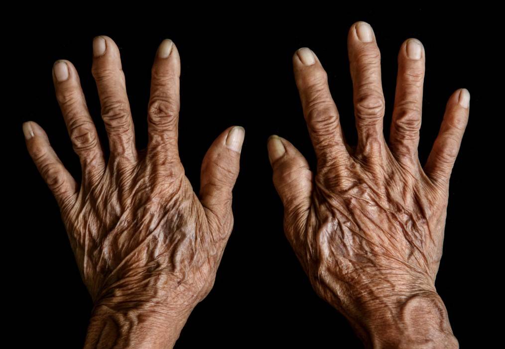 rejuvenescimento de mãos envelhecidas