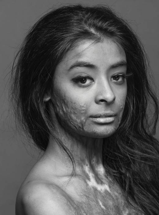 plástica para queimadura