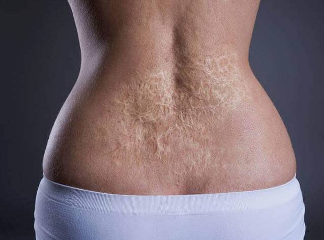 tratamento de queimadura