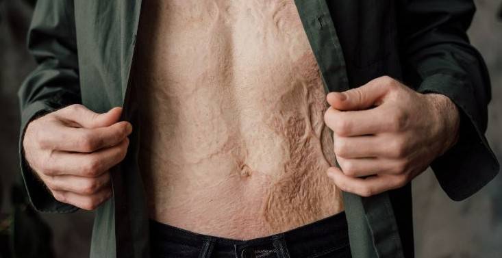 cicatriz de queimadura