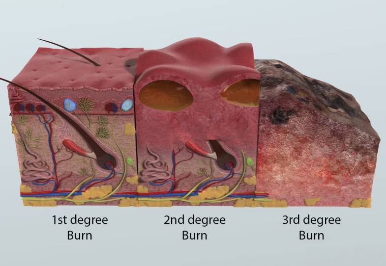 gravidade da queimadura