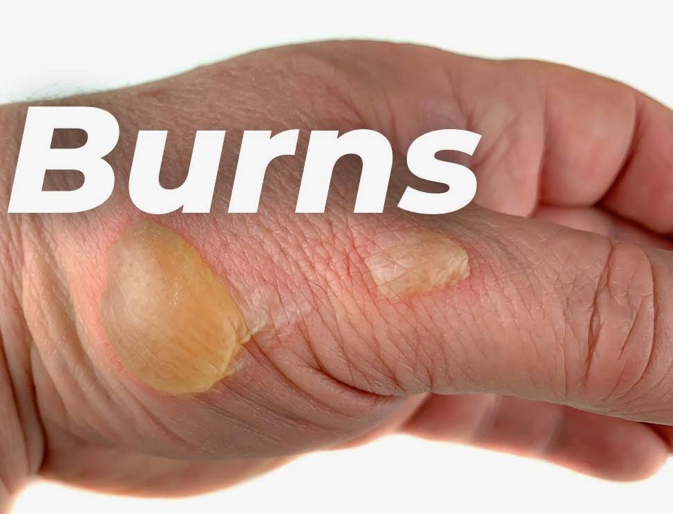 queimadura na mão