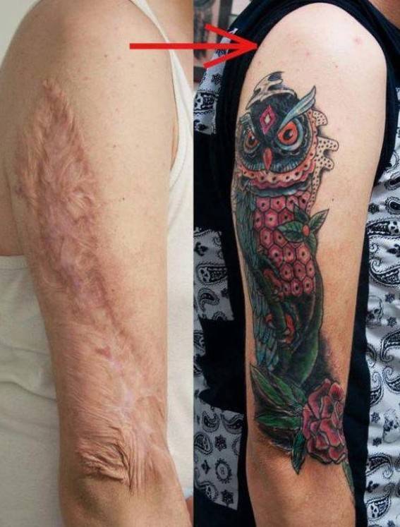 esconder cicatriz de queimadura