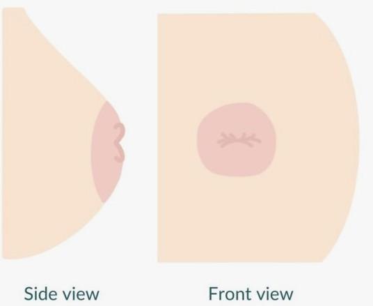 mamilo invertido risco