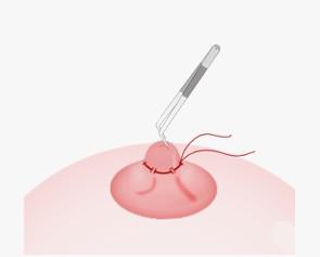 cirurgia para mamilo invertido 