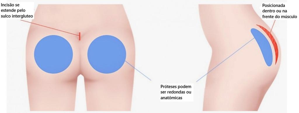 prótese de glúteo