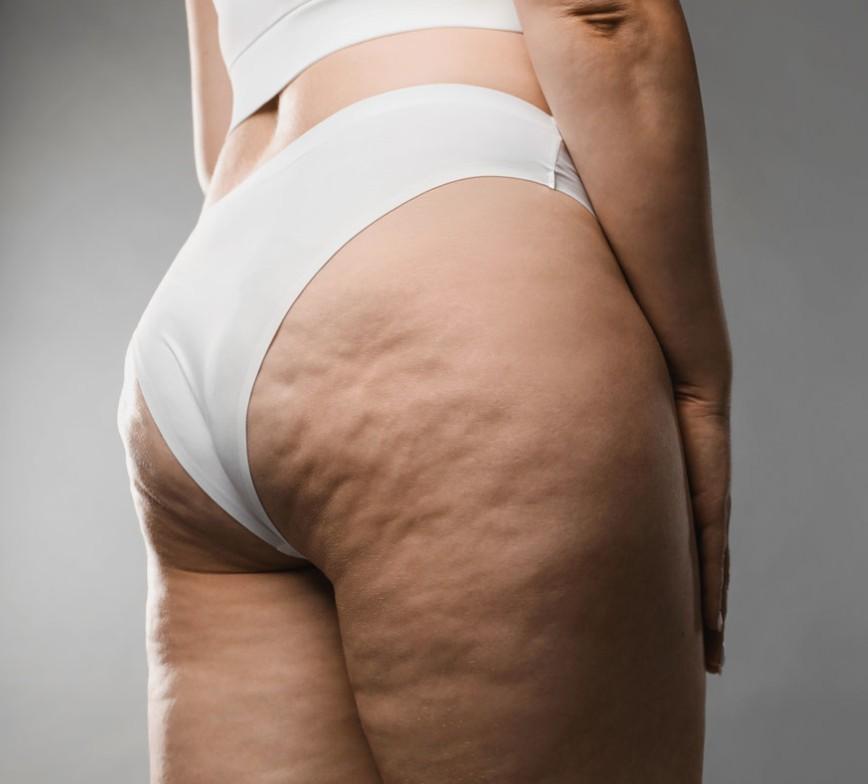 bioplastia para celulite